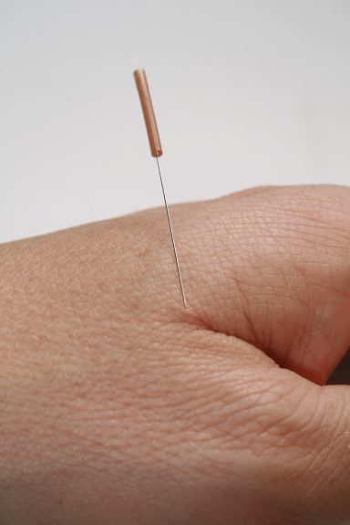 Akupunktur Akupunktur